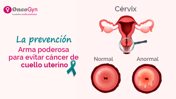 cáncer-de-cuello-uterino-1