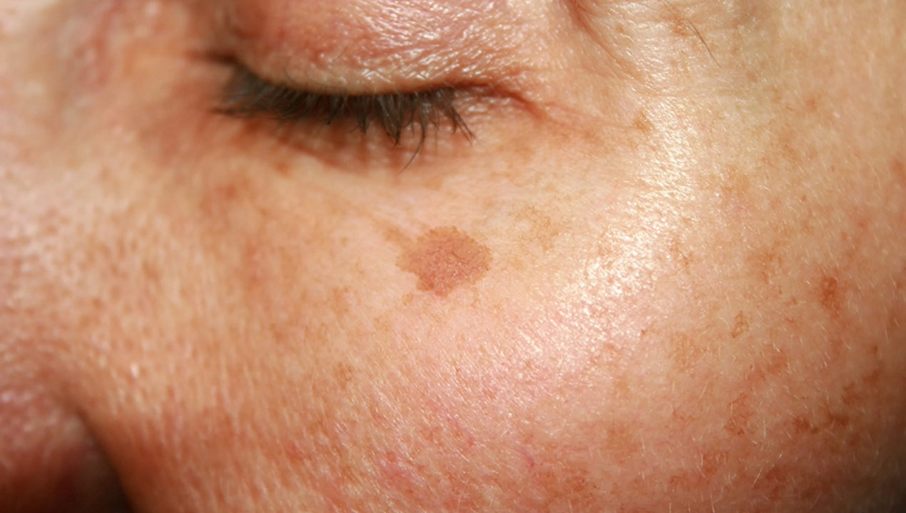 /ua/fotoenvejecimiento-efectos-negativos-de-la-exposicion-solar-acumulada-en